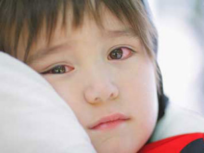 Bài viết tuyên truyền về bệnh đau mắt đỏ